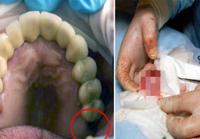 Gigi hilang dari rahang malah tumbuh di testis.