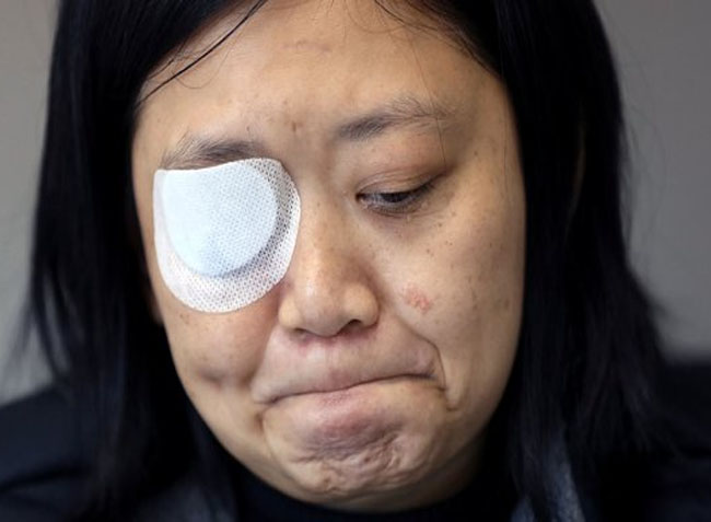 Veby Mega Indah, jurnalis asal Indonesia yang mata kanannya tertembak peluru polisi Hong Kong.