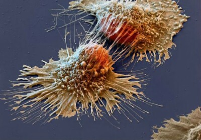 Ilustrasi sel kanker.